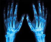 Из-за редкого заболевания у 69-летней женщины сформировались «выдвижные» пальцы