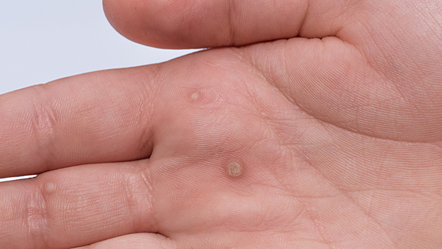 Можно ли удалять бородавки в домашних условиях