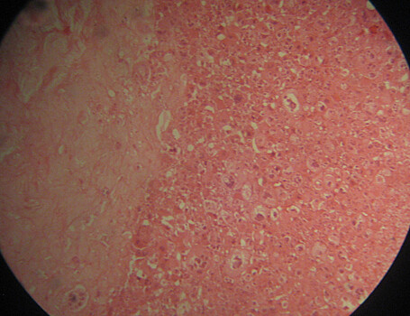 Предложены молекулярные маркеры для диагностики ревматоидного артрита и бронхиальной астмы