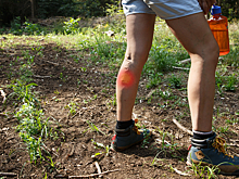 Врач назвал главную опасность COVID-19 при варикозе