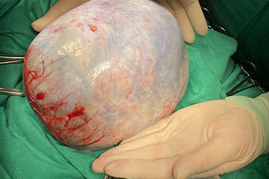 Подмосковные врачи обнаружили у пенсионерки двухкилограммовую опухоль