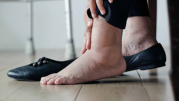 Врач рассказала, почему важно обратить внимание на здоровье ног. Советы пенсионерам
