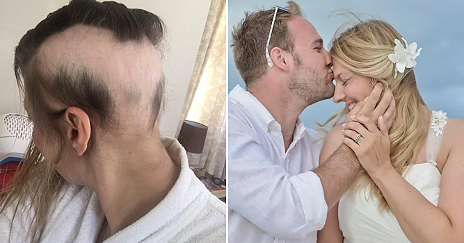 Американка облысела из-за предсвадебной подготовки