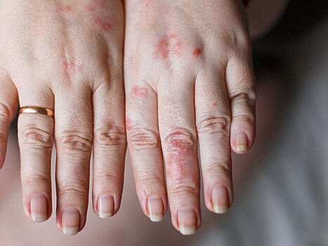 Россиянам рассказали о самой опасной аллергии