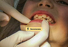Стоматолог-терапевт Сошников: ребёнка нужно обязательно показать ортодонту в 6 и 11 лет