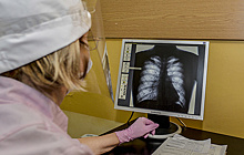 Эксперт заявил, что в России летальность от пневмонии находится на доковидном уровне