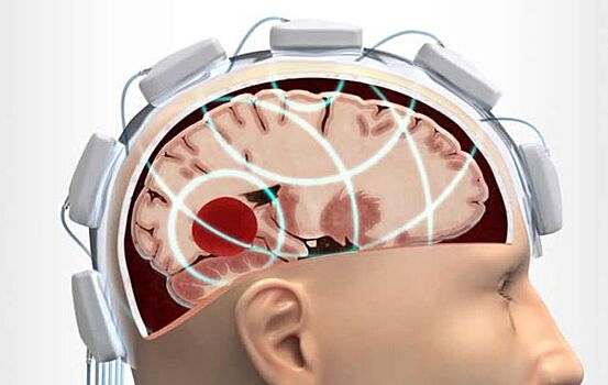 Шведы создали устройство для обследования мозга вне больниц