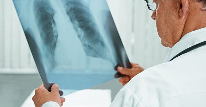 Эксперт назвал входящих в группу риска по заражению туберкулезом