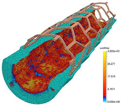 3D-модель коронарного сосуда поможет предотвратить болезни сердца