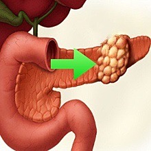 Почему рак поджелудочной железы такой агрессивный?