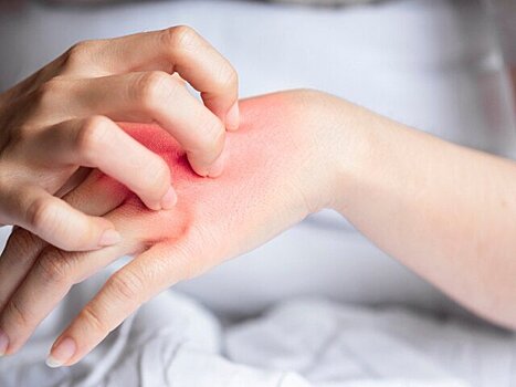 В России сезон аллергии начнется раньше срока из-за теплой зимы