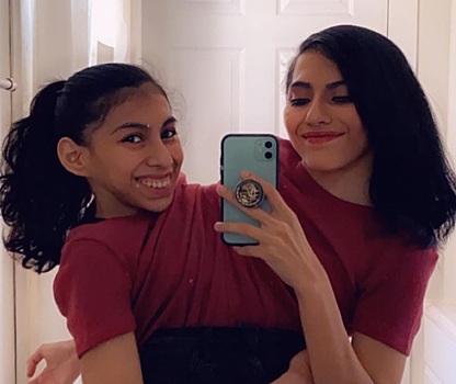 18-летние сиамские близнецы отказались от разделения