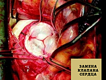Замена клапана сердца может спасти жизнь