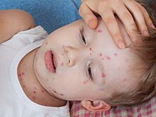 Аллерголог Гучапшева: инкубационный период ветрянки у детей может длиться до 21 дня