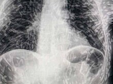 Ученые поделились рентгеном человека, тело которого было усеяно яйцами паразита