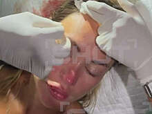 SHOT: на Бали туристка из РФ оглохла после удара стеклянной бутылкой