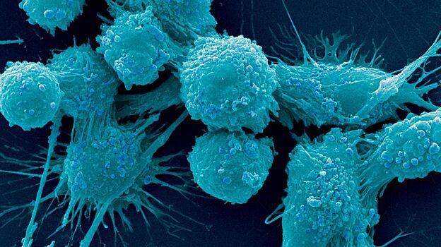 Раннюю стадию рака научились диагностировать с помощью протеина малярии