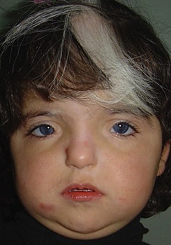 Синдром Ваарденбурга: типы, симптомы и причины