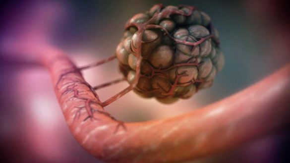 LIFE: Хирург Паршин назвал недолеченный ларингит причиной рака трахеи