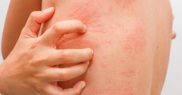 В Сызрани зафиксирована вспышка одного из опасных заболеваний кожи