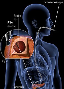 Новая технология поможет выявить рак поджелудочной железы на ранних стадиях