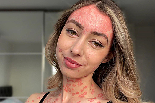 Девушка с заболеванием кожи показала свое тело и восхитила подписчиков