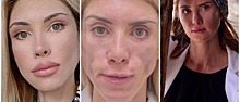 4 года — 4 лица у девушки, которая хотела подкорректировать внешность: Как одни пластические хирурги красоту загубили, а другие возвращают