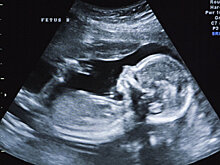 Женщина забеременела во время беременности