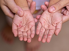 В Госдуме раскрыли причину роста заболеваемости корью и коклюшем