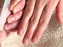 Белые полоски на ногтях назвали симптомом туберкулеза
