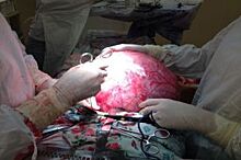 Алтайские хирурги вырезали две огромные опухоли у пациенток