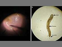 Из-за паразита мужчине пришлось высосать стекловидное тело глаза