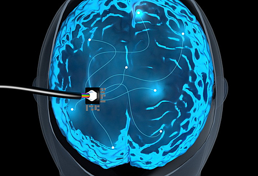 Пациенту имплантировали в мозг электроды для лечения депрессии