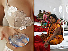 Бедным жителям Индии начнут бесплатно делать пластику груди