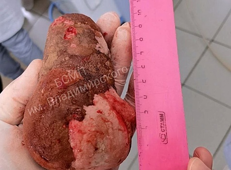 В Арзамасе хирурги удалили из мочевого пузыря пациента «царь-камень»