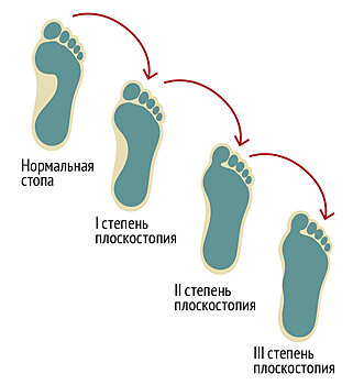 Плоскостопие: симптомы, причины и методы профилактики