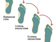Плоскостопие: симптомы, причины и методы профилактики