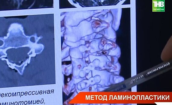 Молодой врач из РКБ первым в Татарстане провел ламинопластику — видео