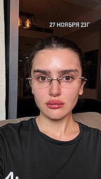 Дина Саева показала, как выглядит после неудачного увеличения губ