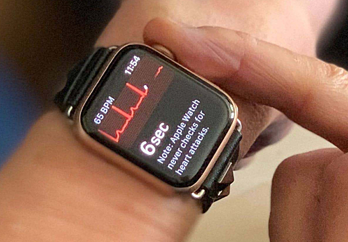 Apple Watch обнаружили проблемы сердца, упущенные больничным ЭКГ-аппаратом
