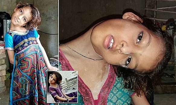 Мир под прямым углом: шея 11-летней пакистанки вывернута на 90 градусов
