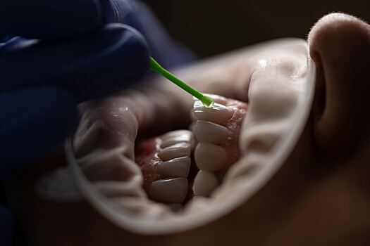 Стоматолог рассказал подробности о процедуре имплантации зубов