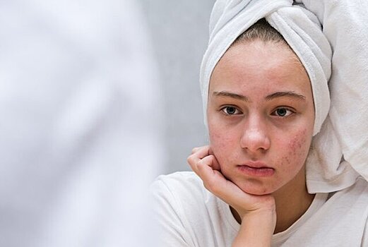 Врач Кливитская: кофеиносодержащие напитки и быстрые углеводы приводят к акне
