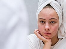 Диетолог предупредила о продуктах, вызывающих акне