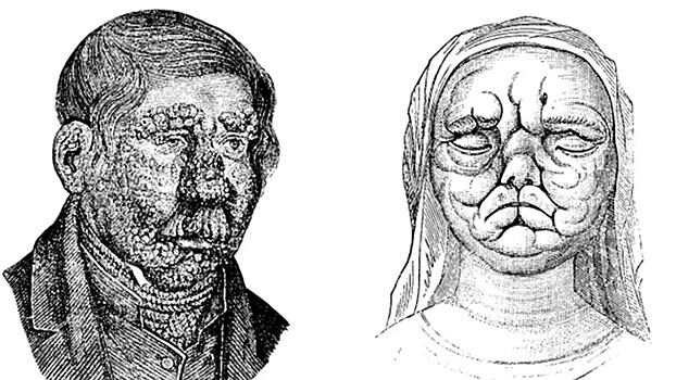 Названа одна из первых болезней, поразивших человечество