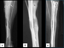 Имплантаты для аппарата Илизарова в два раза сократили срок удлинения костей