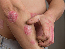 Псориаз оказался связан с нарушениями сна