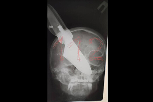 На Кубани в ходе семейной ссоры мужчина воткнул нож в лицо своей супруги