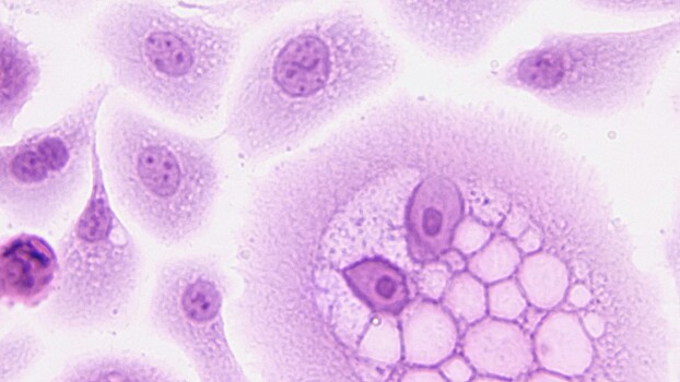 Онколог рекомендовал не увлекаться самодиагностикой рака