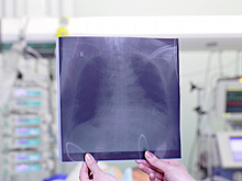 Врач рассказала, кто имеет риски остеопороза